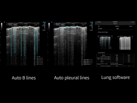 elegir un ultrasonido